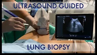 US-guided lung biopsy