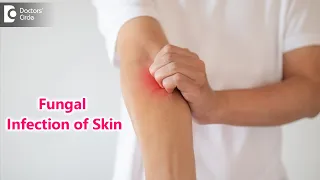 Skin Mycosis: Symptoms, Causes & Treatment | Fungal Infection - Dr. Rajdeep Mysore | Doctors' Circle