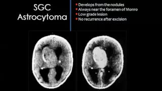 Imaging of pediatric brain tumors II    DRE 6   Dr Mamdouh Mahfouz