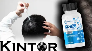 KX-826 Update: New Clinical Trial at 1% (HAIR LOSS NEWS)