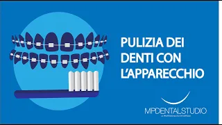 Come pulire i denti con l'apparecchio fisso