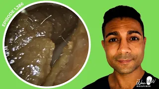 1,386 - 11 Ear Wax Removals in One Video