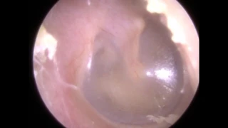 202: Ear Hook used to Remove Deep Dry Ear Wax - Mr Neel Raithatha (The Hear Clinic)