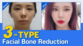 ■Facial Contouring Recovery Process 5■ [Before & After]