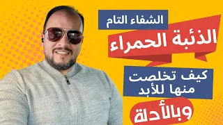 الذئبة الحمراء ورحلة الشفاء التام / lupus / sle