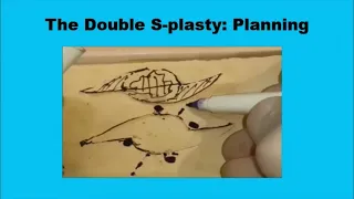 (4) The Double S plasty technique