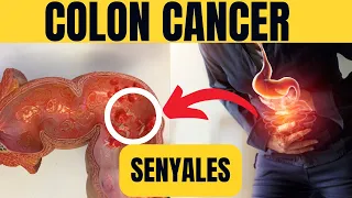 10 SENYALES NG COLON CANCER | 10 WARNING SIGNS NG COLON CANCER NA DI DAPAT BALEWALAIN