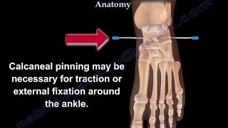 Calcaneal Pin Insertion Anatomy - Everything You Need To Know - Dr. Nabil Ebraheim