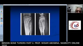 Benign bone tumors part 2. Prof. Wisam Abosena . nasrcity covid19 time online lectures 2020