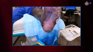 WCW: Applying the Derma Gide Graft with Sutures