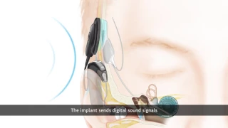 How the Cochlear Nucleus 6 Hybrid System Works