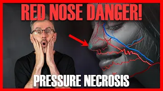 RED NOSE TIP COMPLICATION. Pressure necrosis after non-surgical rhinoplasty [Aesthetic Mastery Show]