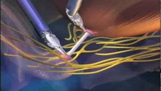 What is a robotic prostatectomy?