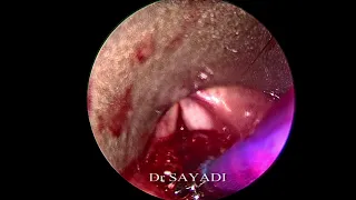 Dilatation trachéale