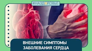 #НАЗДОРОВЬЕ: внешние симптомы заболевания сердца