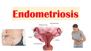 Endometriosis | Causes, Pathophysiology, Symptoms, Diagnosis & Treatment