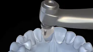 Creating an Immediate Screw Retained Temporary Using the Tall Titanium Cylinders