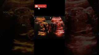 Fetal kidney Hydronephrosis  #ultrasound#shorts