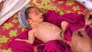 Inserting a Nasogastric Tube - Small Baby Series