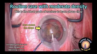 CataractCoach 1311: routine cataract case with moderate density