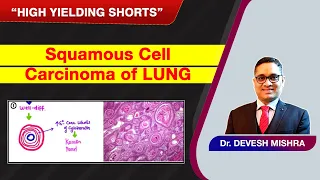 High Yielding Shorts-93 (#HYS-93):Squamous cell carcinoma of LUNG by Dr Devesh Mishra