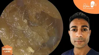 1,370 - 11 Ear Wax Removal Videos