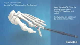 Молоткообразный палец