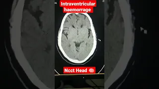 Ncct head intraventricular haemorrage #viral #shorts #reels #bleeding #science #ctscan #neurology