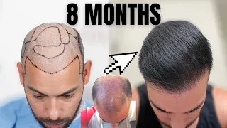 8 Month Hair Transplant Update 4000 Grafts 9K Total