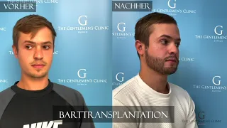 Barttransplantation 6 Monate, vorher / nachher