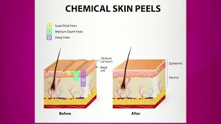 Chemical Peel: Purpose & Types