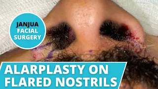 NOSTRIL NARROWING (ALARPLASTY) ON FLARED NOSTRILS - DR. TANVEER JANJUA - NEW JERSEY