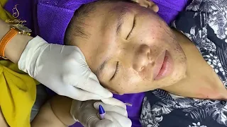 Loan Nguyen Acne Treatment 1626mh