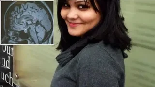 Woman Fully Recovering after Surgeon Remove Embryonic Twin In her Brain