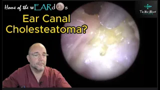 Ear Canal Cholesteatoma? 180 #ear #earwax #earwaxremoval #earcleaning  #asmr #asmrearwax #satisfying