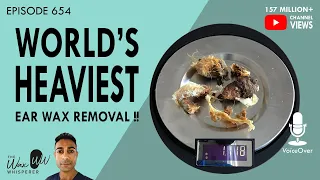 654 - WORLD'S HEAVIEST EAR WAX REMOVAL (+1 GRAM) !!