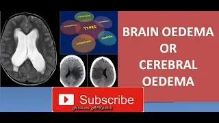 BRAIN OEDEMA OR CEREBRAL OEDEMA