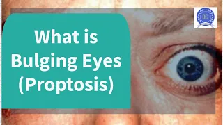 What is Proptosis or Bulging Eyes?