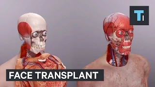 Face transplant