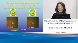 MicroPulse Mechanism of Action in the Treatment of DME - Dr. Kishiko Okhoshi