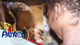 Mga hakbang kontra monkeypox kasado na: DOH | TV Patrol