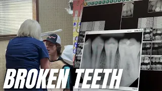 Two broken Teeth And Four Cracked Teeth | Dentist Repairs Teeth After Sledding Accident