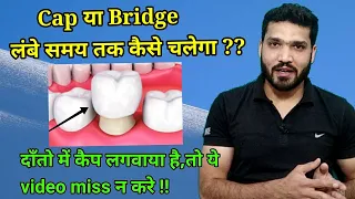 Tooth cap लगवाने के बाद क्या करे जिससे हमेशा अच्छा रहे ?? Precautions for tooth cap and Bridge