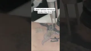 Laser tattoo removal first treatment