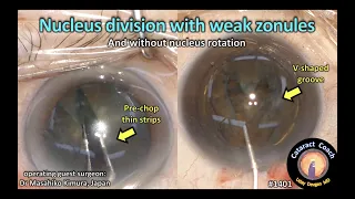 CataractCoach 1401: nucleus division with weak zonules