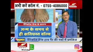 क्या होता है Varicose Veins ? जानें इसका उपचार | AYUSHMAN