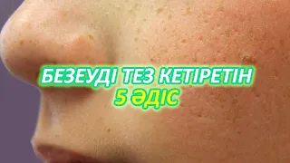 Беттегі Безеуді Угри Кетірудің ең Оңай Әдісі, Керек арнасы