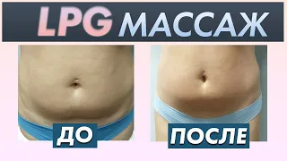 Аппаратный массаж для похудения | LPG массаж, RF лифтинг, советы косметолога