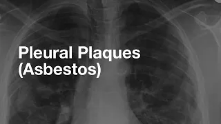 Asbestos-Related Pleural Plaques