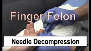 Needle Decompression of Finger Felon